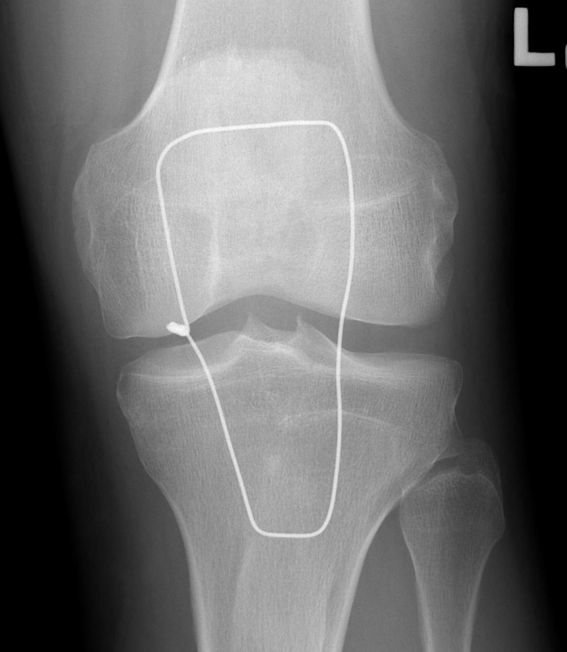 Patella Box Wire AP